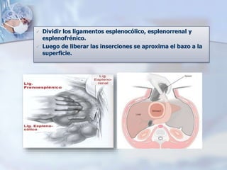  Dividir los ligamentos esplenocólico, esplenorrenal y
esplenofrénico.
 Luego de liberar las inserciones se aproxima el bazo a la
superficie.
 