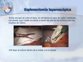 Esplenectomía laparoscópica
Una vez que se corta el bazo, se introduce un saco de nailon resistente
con jareta, cuyo cuello se extrae a través de uno de los orificios para los
trocares de 10mm.
El bazo se tritura dentro de la bolsa y se lo extrae
 