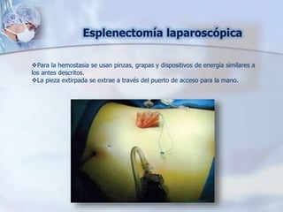Esplenectomía laparoscópica
Para la hemostasia se usan pinzas, grapas y dispositivos de energía similares a
los antes descritos.
La pieza extirpada se extrae a través del puerto de acceso para la mano.
 