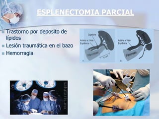 ESPLENECTOMIA PARCIAL
 Trastorno por deposito de
lípidos
 Lesión traumática en el bazo
 Hemorragia
 