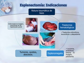 Esplenectomía: Indicaciones
Rotura traumática de
bazo
Trastornos
hematológicos
Esplenomegalia
Tumores, quistes,
abscesos.
Enfermedad de Hodgkin,
aneurismas de AE,
hipertensión portal
Trastornos eritrociticos,
leucocíticos y plaquetarios
Leucemia,
amiloidosis,
linfoma no
Hodgkin,
policitemia.
 