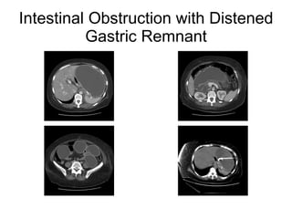 Intestinal Obstruction with Distened Gastric Remnant 