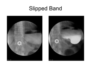 Slipped Band 