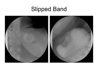 Slipped Band 