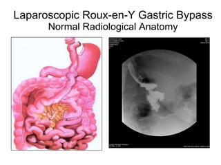 Laparoscopic Roux-en-Y Gastric Bypass Normal Radiological Anatomy 