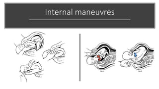 Internal maneuvres
 