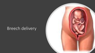 Breech delivery
 