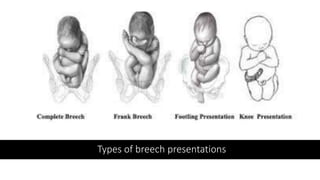 Types of breech presentations
 