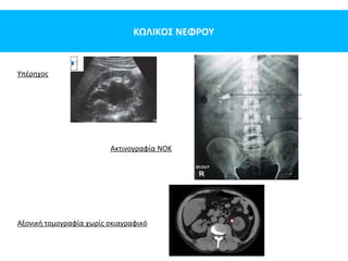 ΚΩΛΙΚΟΣ ΝΕΦΡΟΥ
Υπέρηχος
Ακτινογραφία ΝΟΚ
Αξονική τομογραφία χωρίς σκιαγραφικό
 