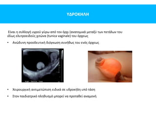 ΥΔΡΟΚΗΛΗ
Eίναι η συλλογή υγρού γύρω από τον όρχι (ανατομικά μεταξύ των πετάλων του
ιδίως ελυτροειδούς χιτώνα (tunica vaginale) του όρχεως
• Ανώδυνη προοδευτική διόγκωση συνήθως του ενός όρχεως
• Χειρουργική αντιμετώπιση ειδικά σε υδροκήλη υπό τάση
• Στον παιδιατρικό πληθυσμό μπορεί να προταθεί αναμονή
 