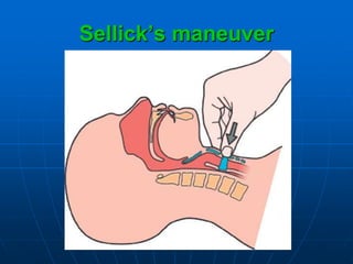 Sellick’s maneuver
 