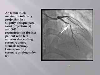 C
An 8 mm thick
maximum intensity
projection in a
slightly oblique para-
axial projection (a)
and 3-D
reconstruction (b) in a
patient with left
anterior descending
coronary artery
stenosis (arrow).
Corresponding
coronary angiography
(c).
 