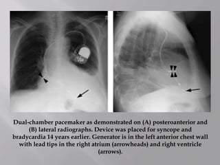 Dual-chamber pacemaker as demonstrated on (A) posteroanterior and
(B) lateral radiographs. Device was placed for syncope and
bradycardia 14 years earlier. Generator is in the left anterior chest wall
with lead tips in the right atrium (arrowheads) and right ventricle
(arrows).
 