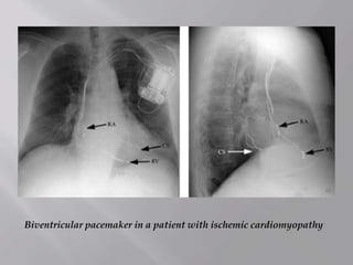 Biventricular pacemaker in a patient with ischemic cardiomyopathy
 