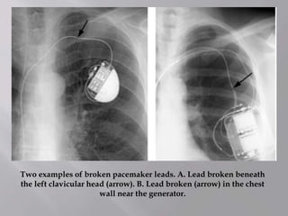 Two examples of broken pacemaker leads. A. Lead broken beneath
the left clavicular head (arrow). B. Lead broken (arrow) in the chest
wall near the generator.
 
