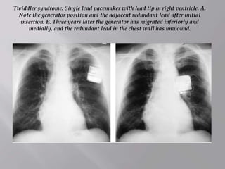 Twiddler syndrome. Single lead pacemaker with lead tip in right ventricle. A.
Note the generator position and the adjacent redundant lead after initial
insertion. B. Three years later the generator has migrated inferiorly and
medially, and the redundant lead in the chest wall has unwound.
 