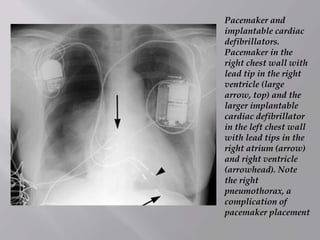 Pacemaker and
implantable cardiac
defibrillators.
Pacemaker in the
right chest wall with
lead tip in the right
ventricle (large
arrow, top) and the
larger implantable
cardiac defibrillator
in the left chest wall
with lead tips in the
right atrium (arrow)
and right ventricle
(arrowhead). Note
the right
pneumothorax, a
complication of
pacemaker placement
 
