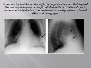 Epicardial implantable cardiac defibrillator patches (arrows) that required
thoracotomy to implant, with epicardial leads that extend to a device in
the anterior abdominal wall, as demonstrated on (A) posteroanterior and
(B) lateral radiographs.
 