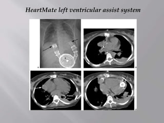 HeartMate left ventricular assist system
 