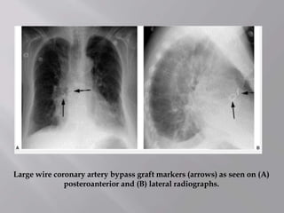 Large wire coronary artery bypass graft markers (arrows) as seen on (A)
posteroanterior and (B) lateral radiographs.
 