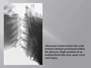 Abnormal endotracheal tube with
balloon inflated positioned within
the pharynx. High position of an
endotracheal tube may cause vocal
cord injury
 