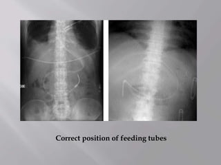 Correct position of feeding tubes
 