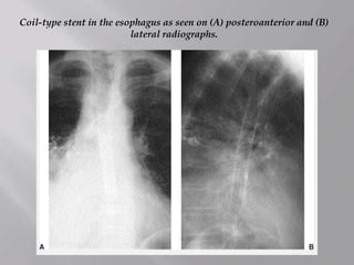 Coil-type stent in the esophagus as seen on (A) posteroanterior and (B)
lateral radiographs.
 