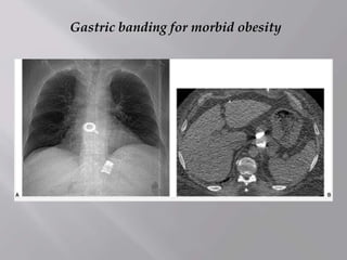 Gastric banding for morbid obesity
 