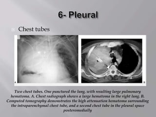  Chest tubes
Two chest tubes. One punctured the lung, with resulting large pulmonary
hematoma. A. Chest radiograph shows a large hematoma in the right lung. B.
Computed tomography demonstrates the high attenuation hematoma surrounding
the intraparenchymal chest tube, and a second chest tube in the pleural space
posteromedially
 