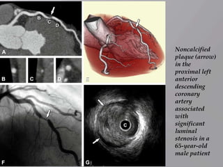 Noncalcified
plaque (arrow)
in the
proximal left
anterior
descending
coronary
artery
associated
with
significant
luminal
stenosis in a
65-year-old
male patient
 