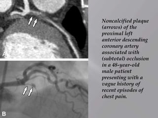 Noncalcified plaque
(arrows) of the
proximal left
anterior descending
coronary artery
associated with
(subtotal) occlusion
in a 48-year-old
male patient
presenting with a
vague history of
recent episodes of
chest pain.
 