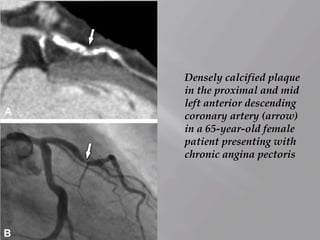 Densely calcified plaque
in the proximal and mid
left anterior descending
coronary artery (arrow)
in a 65-year-old female
patient presenting with
chronic angina pectoris
 