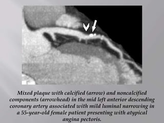 Mixed plaque with calcified (arrow) and noncalcified
components (arrowhead) in the mid left anterior descending
coronary artery associated with mild luminal narrowing in
a 55-year-old female patient presenting with atypical
angina pectoris.
 