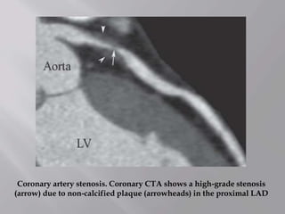 Coronary artery stenosis. Coronary CTA shows a high-grade stenosis
(arrow) due to non-calcified plaque (arrowheads) in the proximal LAD
 