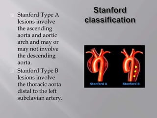  Stanford Type A
lesions involve
the ascending
aorta and aortic
arch and may or
may not involve
the descending
aorta.
 Stanford Type B
lesions involve
the thoracic aorta
distal to the left
subclavian artery.
 
