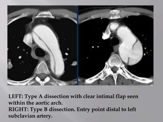LEFT: Type A dissection with clear intimal flap seen
within the aortic arch.
RIGHT: Type B dissection. Entry point distal to left
subclavian artery.
 