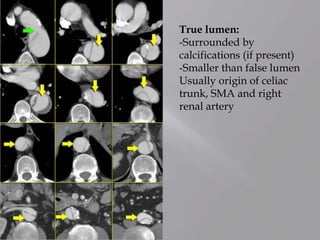 True lumen:
-Surrounded by
calcifications (if present)
-Smaller than false lumen
Usually origin of celiac
trunk, SMA and right
renal artery
 
