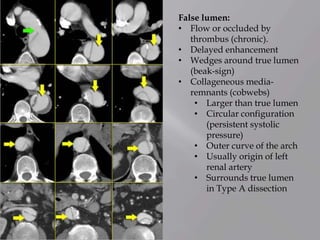 False lumen:
• Flow or occluded by
thrombus (chronic).
• Delayed enhancement
• Wedges around true lumen
(beak-sign)
• Collageneous media-
remnants (cobwebs)
• Larger than true lumen
• Circular configuration
(persistent systolic
pressure)
• Outer curve of the arch
• Usually origin of left
renal artery
• Surrounds true lumen
in Type A dissection
 