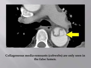 Collageneous media-remnants (cobwebs) are only seen in
the false lumen.
 