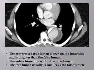 • The compressed true lumen is seen on the inner side
and is brighter than the false lumen.
• Thrombus formation within the false lumen.
• The true lumen usually is smaller as the false lumen
 