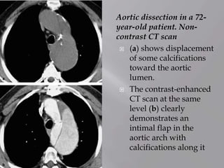 Aortic dissection in a 72-
year-old patient. Non-
contrast CT scan
 (a) shows displacement
of some calcifications
toward the aortic
lumen.
 The contrast-enhanced
CT scan at the same
level (b) clearly
demonstrates an
intimal flap in the
aortic arch with
calcifications along it
 