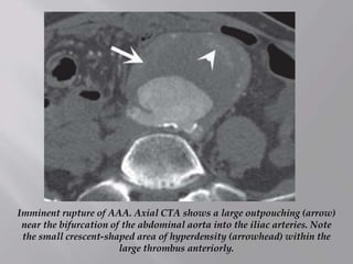 Imminent rupture of AAA. Axial CTA shows a large outpouching (arrow)
near the bifurcation of the abdominal aorta into the iliac arteries. Note
the small crescent-shaped area of hyperdensity (arrowhead) within the
large thrombus anteriorly.
 