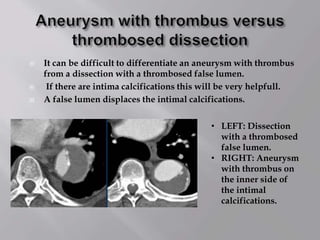  It can be difficult to differentiate an aneurysm with thrombus
from a dissection with a thrombosed false lumen.
 If there are intima calcifications this will be very helpfull.
 A false lumen displaces the intimal calcifications.
• LEFT: Dissection
with a thrombosed
false lumen.
• RIGHT: Aneurysm
with thrombus on
the inner side of
the intimal
calcifications.
 