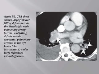Acute PE. CTA chest
shows large globular
filling defects within
the distal right main
pulmonary artery
(arrow) and filling
defects within
segmental pulmonary
arteries in the left
lower lobe
(arrowheads) and a
large rightsided
pleural effusion.
 