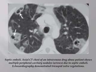 Septic emboli. Axial CT chest of an intravenous drug abuse patient shows
multiple peripheral cavitary nodules (arrows) due to septic emboli.
Echocardiography demonstrated tricuspid valve vegetations.
 
