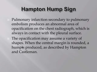  Pulmonary infarction secondary to pulmonary
embolism produces an abnormal area of
opacification on the chest radiograph, which is
always in contact with the pleural surface.
 The opacification may assume a variety of
shapes. When the central margin is rounded, a
hump•is produced, as described by Hampton
and Castleman.
 