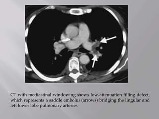 CT with mediastinal windowing shows low-attenuation filling defect,
which represents a saddle embolus (arrows) bridging the lingular and
left lower lobe pulmonary arteries
 