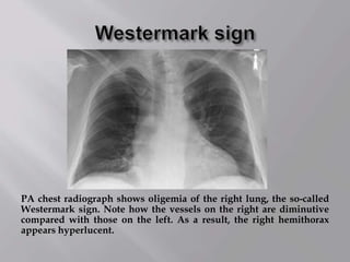 PA chest radiograph shows oligemia of the right lung, the so-called
Westermark sign. Note how the vessels on the right are diminutive
compared with those on the left. As a result, the right hemithorax
appears hyperlucent.
 