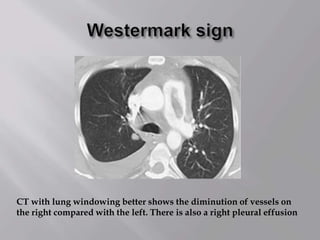 CT with lung windowing better shows the diminution of vessels on
the right compared with the left. There is also a right pleural effusion
 