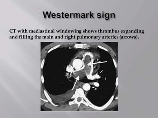 CT with mediastinal windowing shows thrombus expanding
and filling the main and right pulmonary arteries (arrows).
 